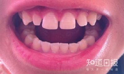 牙齿缝隙大面相（门牙中间有缝隙面相命运）