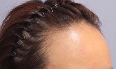 发际线特别高的男人面相（m发际线高的男生面相）