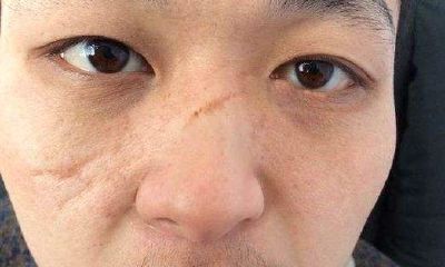 嘴下巴有疤会不会影响财运（十种行为影响财运）